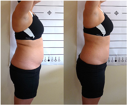 Lipo-Light Body Sculpting | Align Spine Health Center, LLC